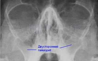 Как читать рентгеновские снимки легких, позвоночника, пазух носа