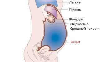 Почему собирается жидкость в животе, причины и лечение