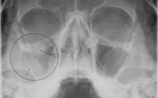 Рентген пазух носа при гайморите: что видно на снимках