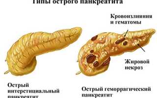 Симптомы и лечение воспаления поджелудочной железы