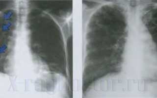 Признаки туберкулеза, которые можно увидеть на рентгене