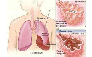Что представляет собой гнойно деструктивная пневмония?
