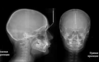 Что значит и когда назначается «рентген и рентгенография головного мозга»?