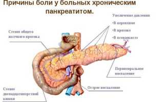 Чем лечить панкреатит поджелудочной железы, симптомы острого и хронического заболевания