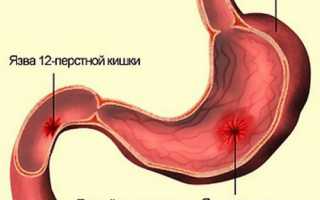 Симптомы язвы кишечника, желудка и двенадцатиперстной кишки