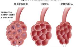 Причины и устранение одышки при воспалении легких