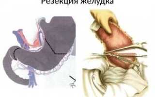 Резекция желудка по Ру: когда и как проводится, реабилитация и прогноз