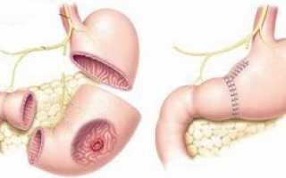 Анастомозит после резекции желудка: что это, как проявляется и лечится
