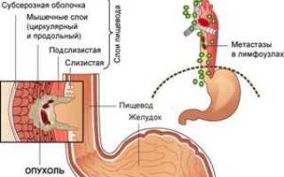 Аденокарцинома пищевода: характерные признаки и возможные осложнения