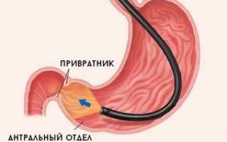 Антральный гастрит: симптомы и диагностические признаки