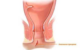 Причины боли в прямой кишке — виды заболеваний