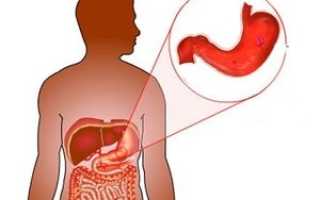 Опухоль желудка: симптомы доброкачественных и злокачественных новообразований