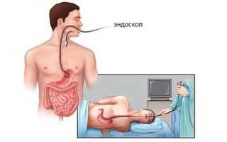 Как называется процедура глотания кишки