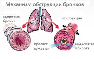 Как протекает острый бронхит у детей?