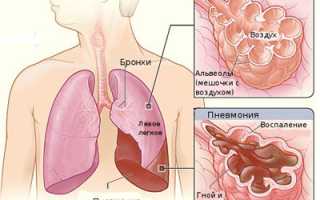 Лечение двухстороннего воспаления легких у пожилых людей