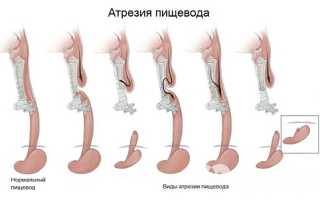 Лечение атрезии пищевода, ее причины и симптомы