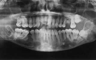Признаки кисты зуба на рентгенограмме