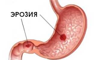 Как лечить эрозию желудка народными средствами