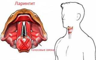 Особенности ларингита и пневмонии