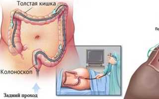 Почему болит живот после колоноскопии