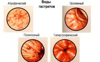 Медикаментозное лечение эрозивного гастрита желудка