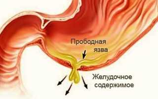 Лечение перфоративной язвы желудка, ее симптомы