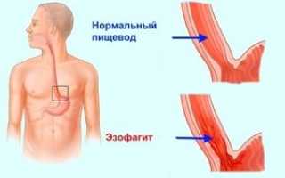 Воспаление пищевода: что это такое, у кого возникает и чем опасен эзофагит