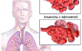 Чем опасна центрилобулярная эмфизема лёгких?