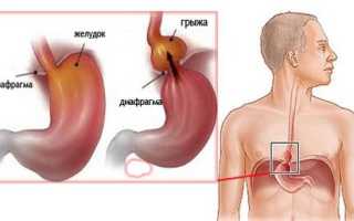 Грыжа пищевода: симптомы и признаки, которые указывают на наличие ГПОД