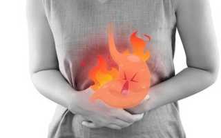 Повышенная кислотность желудка: симптомы и признаки, методы диагностики