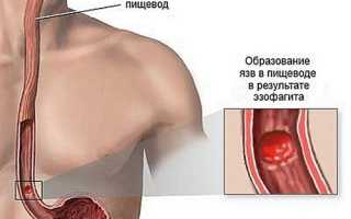 Лечение язвы пищевода, ее виды, причины появления и симптомы