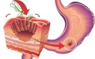 Язвенная болезнь желудка у детей: какими симптомами проявляется и как лечится