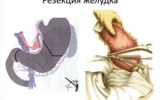 Виды и этапы резекции желудка, реабилитационный период