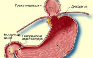 Грыжа пищеводного отверстия диафрагмы: что это такое, симптомы и лечение