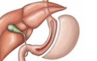 Удаление желудка: показания и подготовка к гастрэктомии, образ жизни после операции