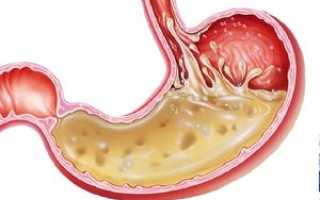 Состав желудочного сока: что включает в себя многокомпонентная биологическая жидкость