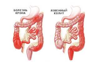 Лечение язвенного колита кишечника, его причины и симптомы