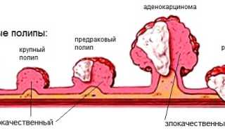 Первые признаки и симптомы рака кишечника