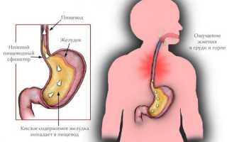 Эрозивный рефлюкс эзофагит: самые важные симптомы и как его вылечить