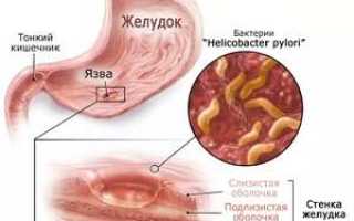Язва желудка: что это такое и как проявляется, виды, лечение, чем опасна