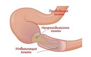 Признаки и виды непроходимости кишечника, ее симптомы и лечение