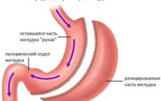 Шунтирование желудка: что это такое, подготовка, стоимость в Москве