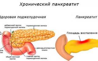 Виды лечебных трав при панкреатите поджелудочной железы
