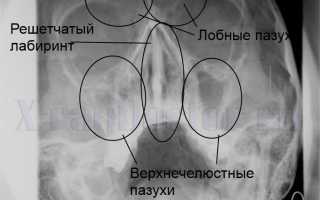 Что видно на рентгене носовых пазух