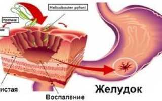 Рак антрального отдела желудка: причины, виды, лечение и прогноз выживаемости