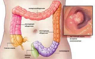 Первые симптомы рака в прямой кишке, его виды и стадии