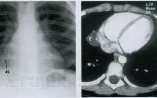 Патология легких на рентгенограмме: корни, кисты и затемнения