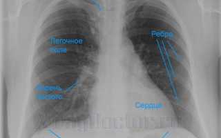Описание рентгеновских снимков грудной клетки в норме и при патологических изменениях