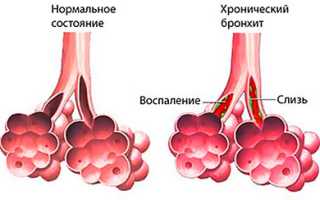 Симптомы и лечение острого и хронического бронхита