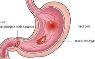 Боли при язве желудка: причины и разновидности, как купировать